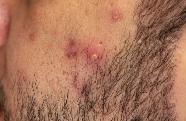 Dermatitis seborreica: qué es y cómo prevenirla