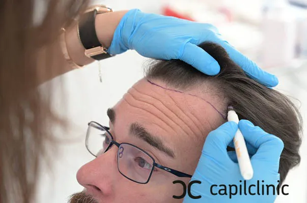 Todo sobre la alopecia: causas, tipos, diagnóstico y tratamientos médicos 15 Todo sobre la alopecia: causas, tipos, diagnóstico y tratamientos médicos