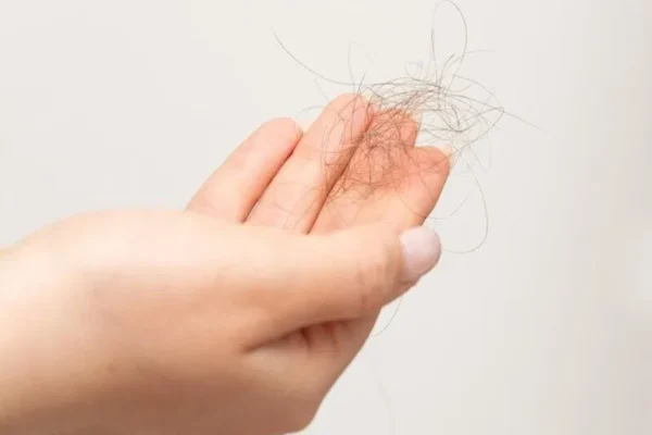 Le syndrome des ovaires polykystiques et la perte de cheveux sont-ils liés ?