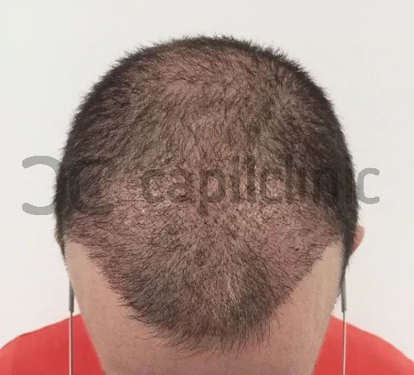 Evolución del injerto capilar día a día 7 Evolución del injerto capilar día a día