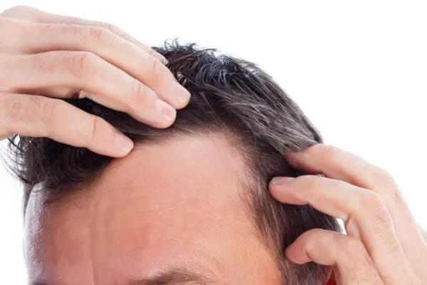 Falta de cabello: señales de alerta