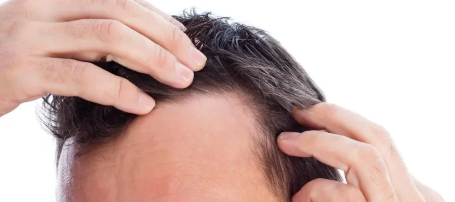 Falta de cabello: señales de alerta