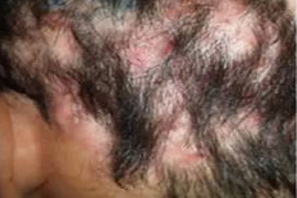 Foliculitis decalvante, conoce sus consecuencias