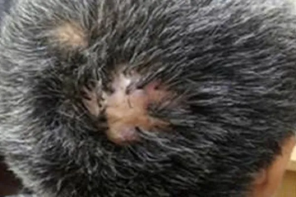 Foliculitis decalvante, conoce sus consecuencias 2 Foliculitis decalvante, conoce sus consecuencias