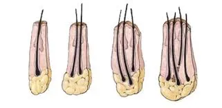 ¿Dónde hacen los mejores implantes de pelo en Barcelona?