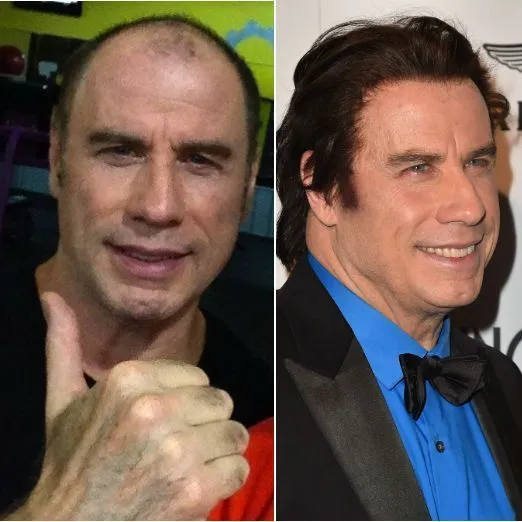 El injerto capilar cada vez tiene más adeptos en Hollywood 4 El injerto capilar cada vez tiene más adeptos en Hollywood