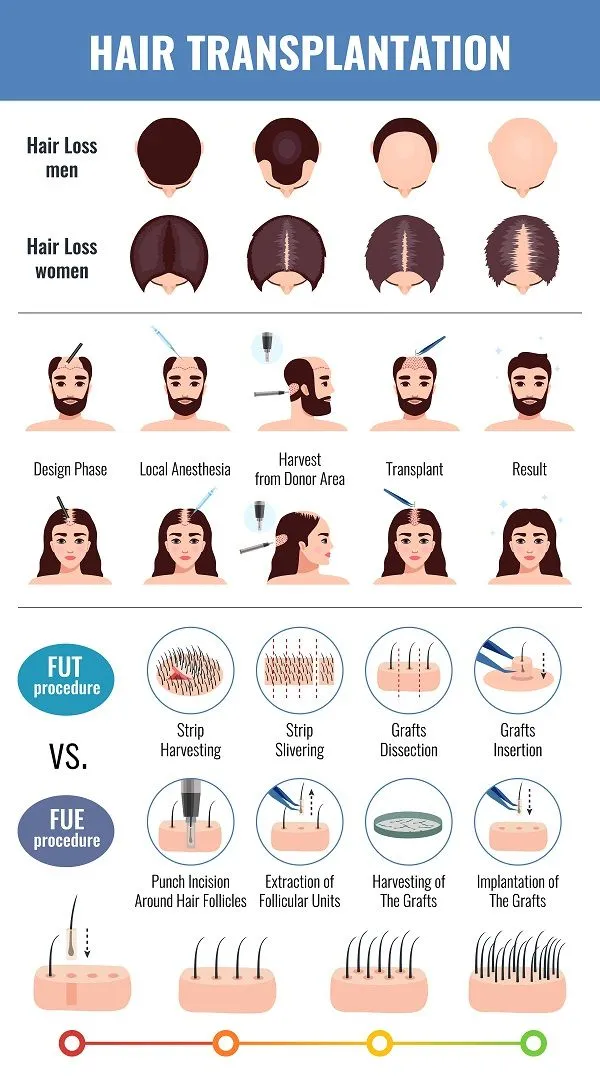 Tipos de trasplantes capilares