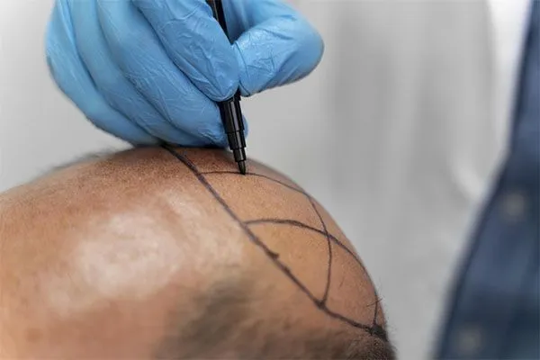 Les personnalités françaises et la greffe de cheveux 4 Les personnalités françaises et la greffe de cheveux