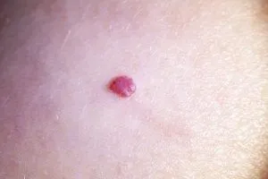 Hemangioma capilar, qué es y cómo quitar 2 Hemangioma capilar, qué es y cómo quitar