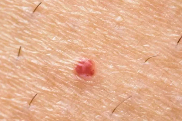Qu’est-ce qu’un hémangiome capillaire et comment l’enlever ?
