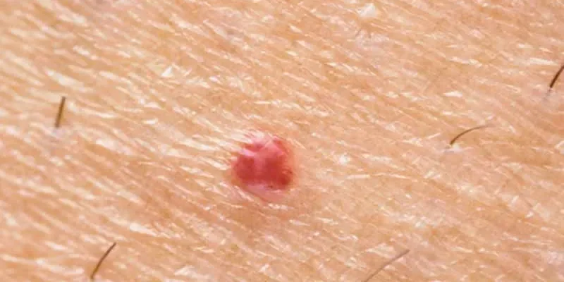 Qu’est-ce qu’un hémangiome capillaire et comment l’enlever ? 1 Qu’est-ce qu’un hémangiome capillaire et comment l’enlever ?