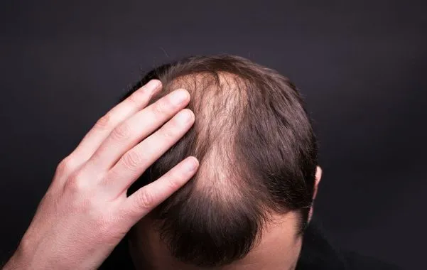 ¿Existe cura para la calvicie? 2 ¿Existe cura para la calvicie?