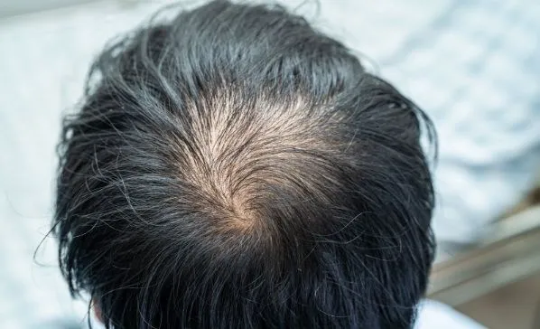 Causas de la pérdida de cabello