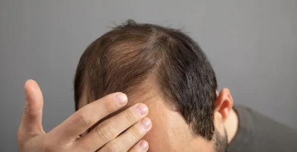 ¿Existe cura para la calvicie? 3 ¿Existe cura para la calvicie?