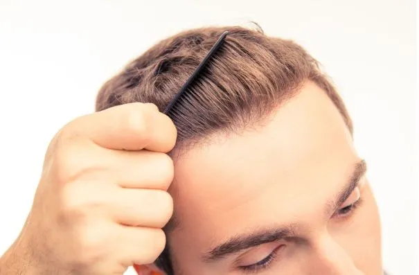 Todo sobre la alopecia: causas, tipos, diagnóstico y tratamientos médicos 20 Todo sobre la alopecia: causas, tipos, diagnóstico y tratamientos médicos