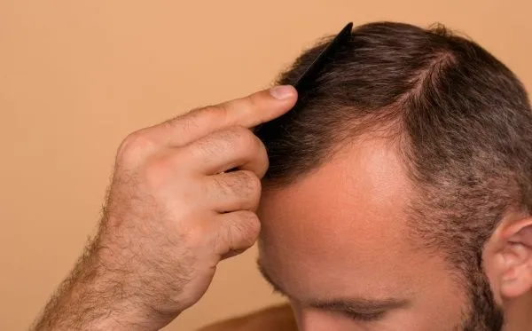 Como peinar el pelo después del trasplante capilar 4 Como peinar el pelo después del trasplante capilar