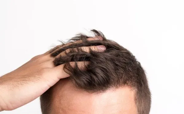 Como peinar el pelo después del trasplante capilar 2 Como peinar el pelo después del trasplante capilar