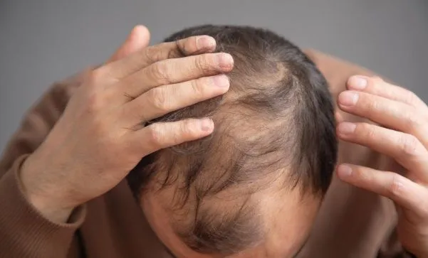 Causas de la pérdida de cabello