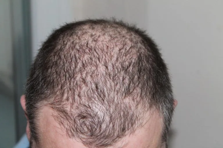 Cómo evitar la caída del pelo con productos naturales