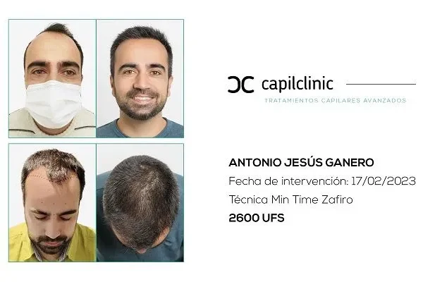 ¿Cómo se hace un implante capilar?