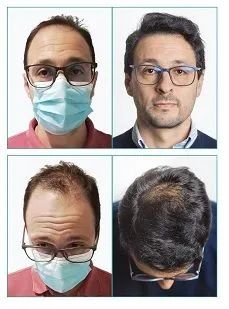 ¿Cómo se hace un implante capilar?