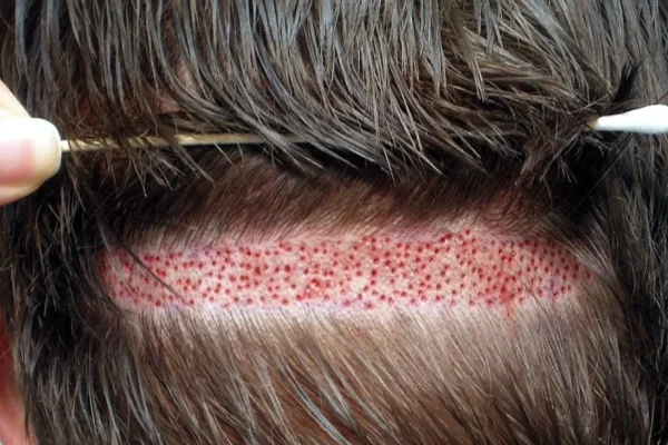 Por qué cada vez más españoles se hacen implantes capilares