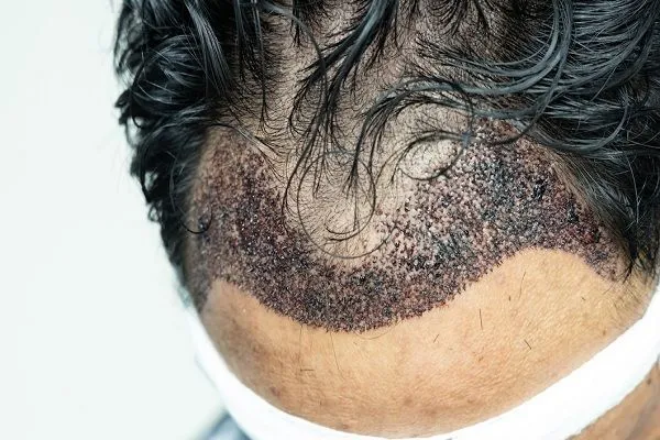 ¿Por qué hay inflamación tras el injerto capilar?