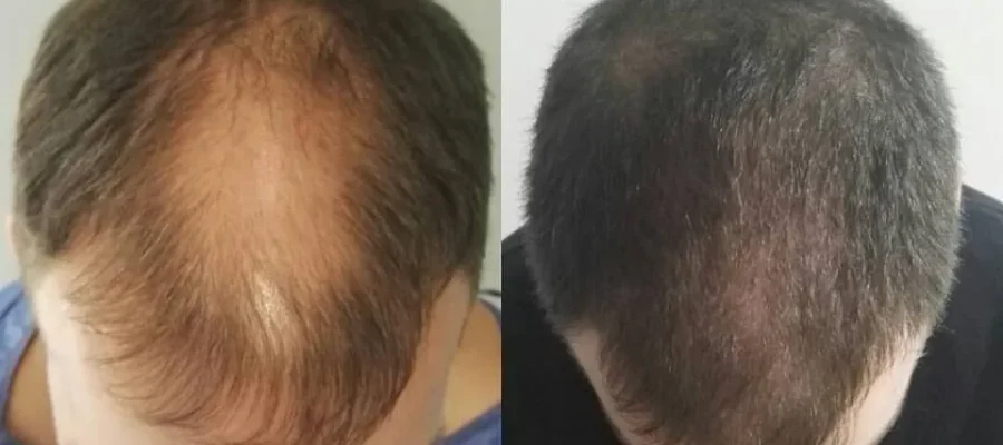 Trasplante capilar FUE: indoloro, rápido y sin cicatrices 1 Trasplante capilar FUE: indoloro, rápido y sin cicatrices
