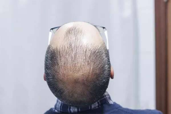 Qu’est-ce que le système d’intégration capillaire ?