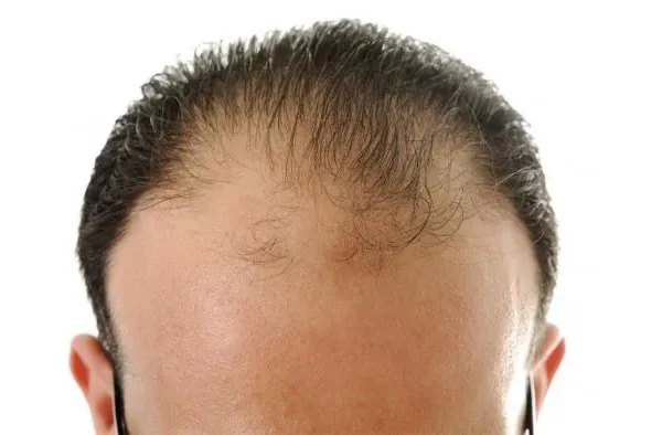 Jeune et chauve, avant 30 ans, que dois-je faire ?