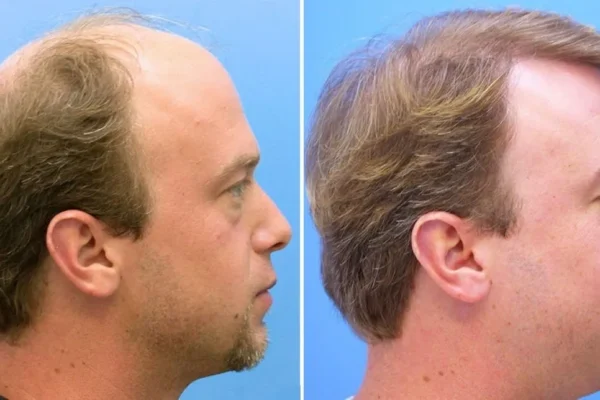 ¿Dónde hacen los mejores implantes de pelo en Barcelona?