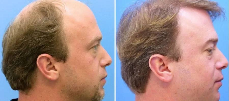 ¿Dónde hacen los mejores implantes de pelo en Barcelona?