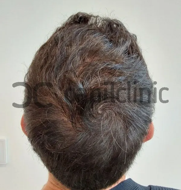 Evolución del injerto capilar día a día 10 Evolución del injerto capilar día a día