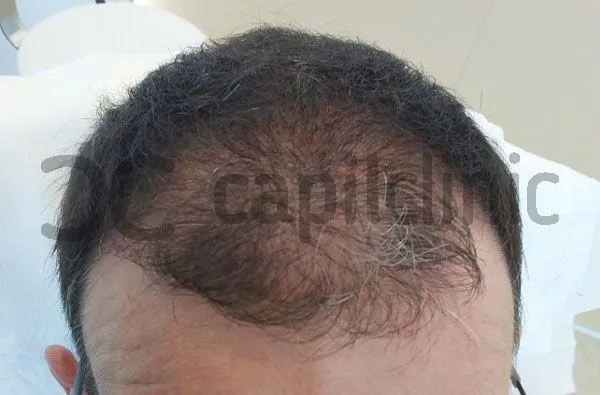 Evolución del injerto capilar día a día 8 Evolución del injerto capilar día a día