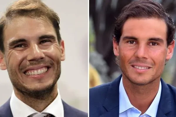 Famosos que se han hecho injertos capilares