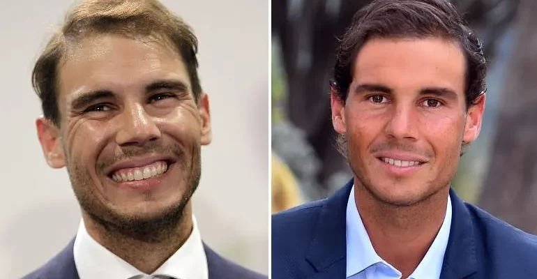 Famosos que se han hecho injertos capilares 1 Famosos que se han hecho injertos capilares