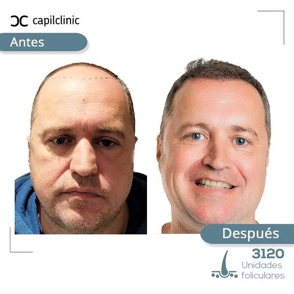 Cómo es el antes y después de un injerto capilar: cronología, fotos reales y evolución mes a mes 4 Cómo es el antes y después de un injerto capilar: cronología, fotos reales y evolución mes a mes