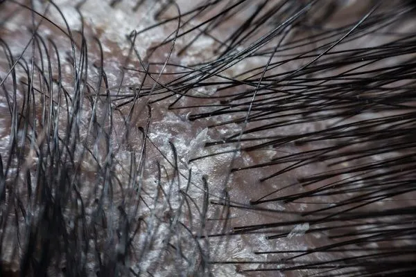 Caída del pelo con raíz blanca, ¿es normal?