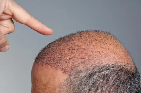 Trasplante capilar: cuánto tiempo tarda en salir el pelo