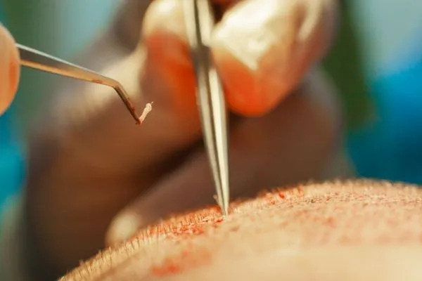 ¿Existe cura para la calvicie? 6 ¿Existe cura para la calvicie?