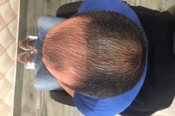 Qu’est-ce qu’un régénérateur de cheveux et où le trouver ?