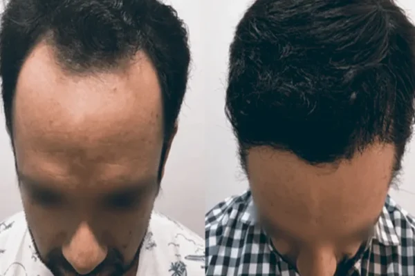 Entradas en el pelo: Hombres y Mujeres