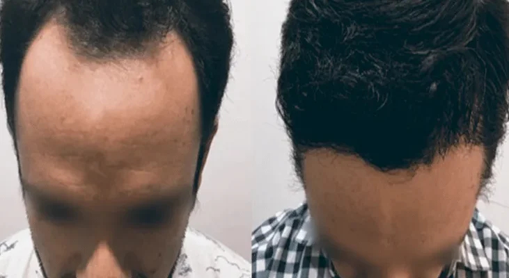 Entradas en el pelo: Hombres y Mujeres 1 Entradas en el pelo: Hombres y Mujeres