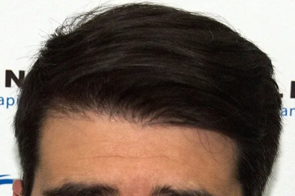 Cómo crece el pelo después del injerto capilar