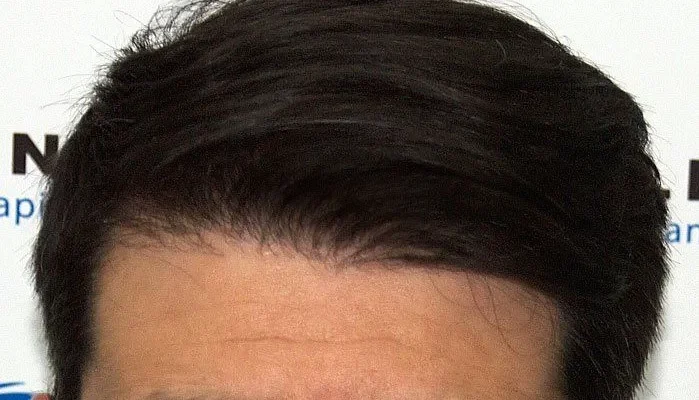 Cómo crece el pelo después del injerto capilar 1 Cómo crece el pelo después del injerto capilar