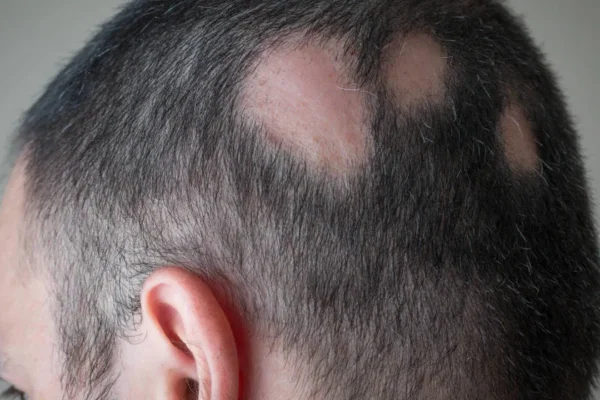 Tipos de alopecia y cómo se tratan