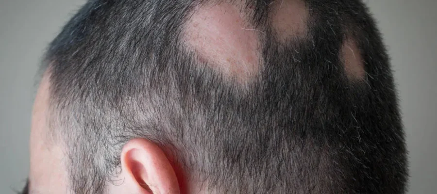 Tipos de alopecia y cómo se tratan 1 Tipos de alopecia y cómo se tratan