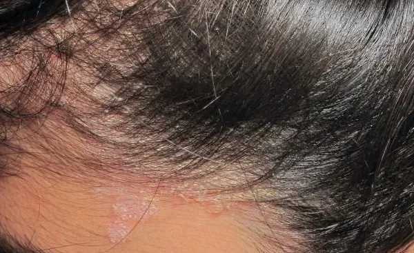 Dermatitis seborreica: qué es y cómo prevenirla