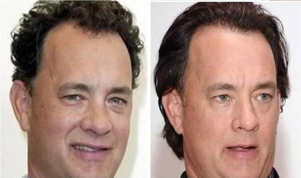 El injerto capilar cada vez tiene más adeptos en Hollywood 8 El injerto capilar cada vez tiene más adeptos en Hollywood