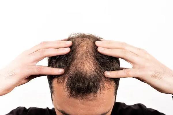 Traitements pour l’alopécie areata 7 Traitements pour l’alopécie areata